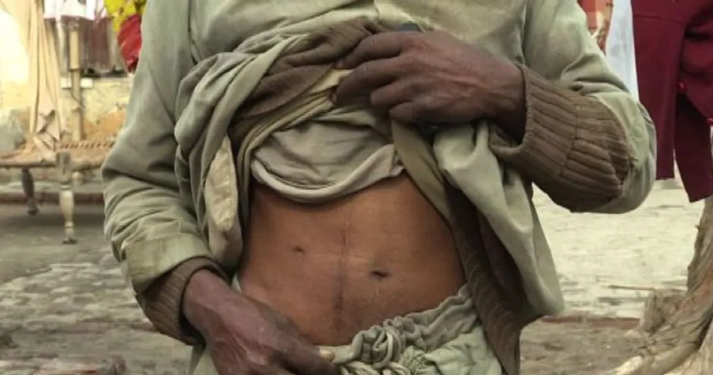 Pakistan, hub del traffico illegale legato al trapianto di reni