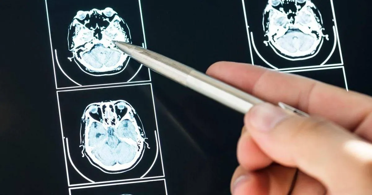 Intelligenza Artificiale pu prevedere evoluzione Parkinson lo studio italiano