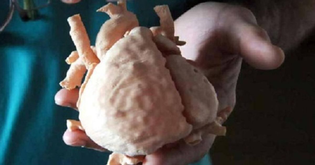 Stampano il cuore in 3D della bambina e le salvano la vita