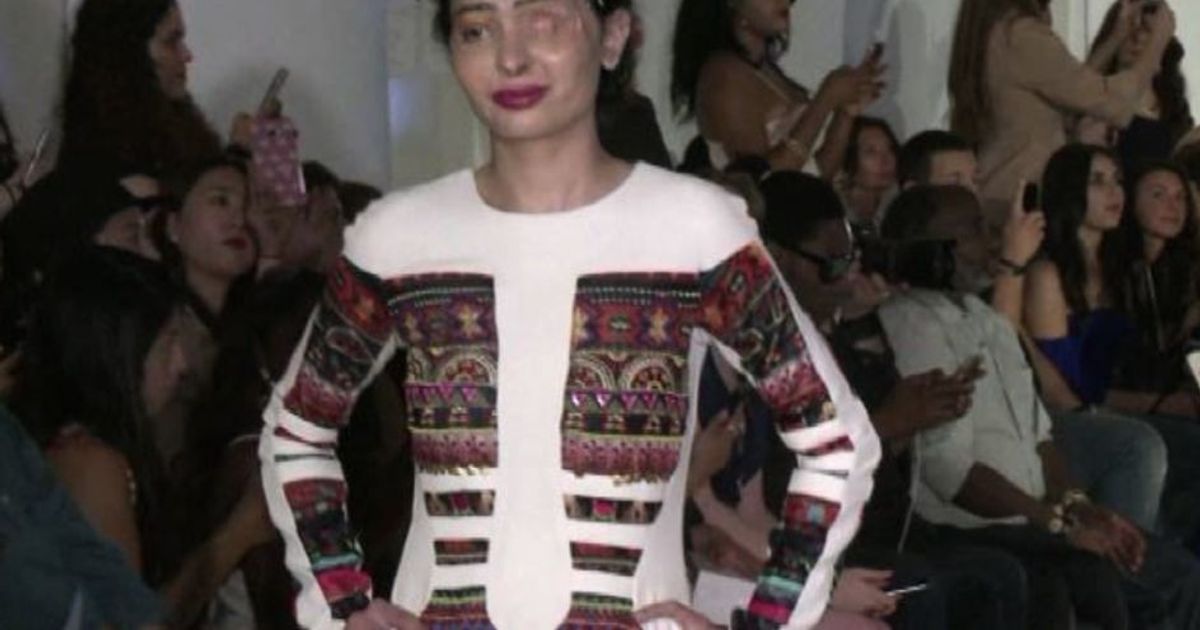 A New York sfila la modella con il volto sfigurato dall8217acido