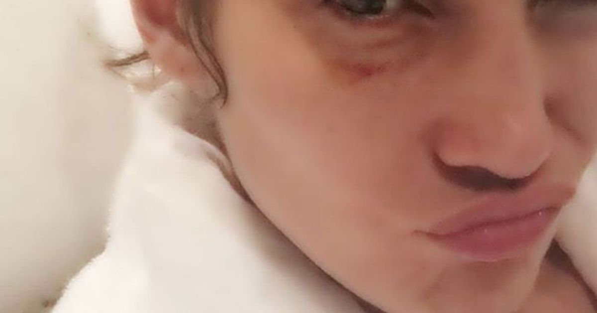 Jennifer Lopez con un occhio nero su Instagram