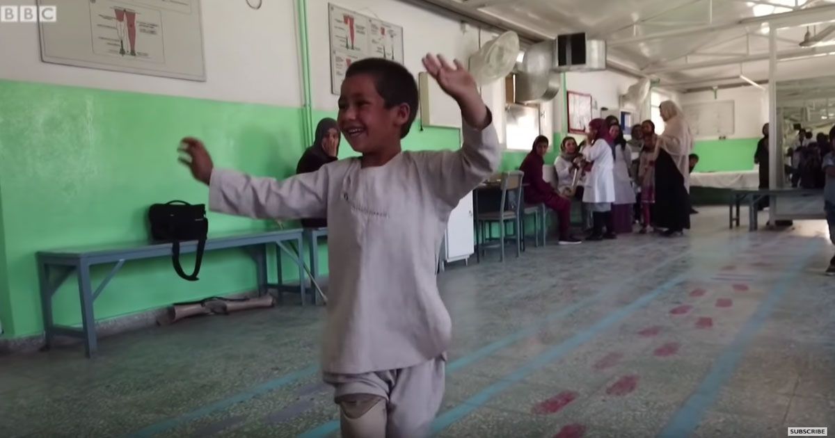 Il bambino torna a danzare grazie ad una protesi: il video è commovente